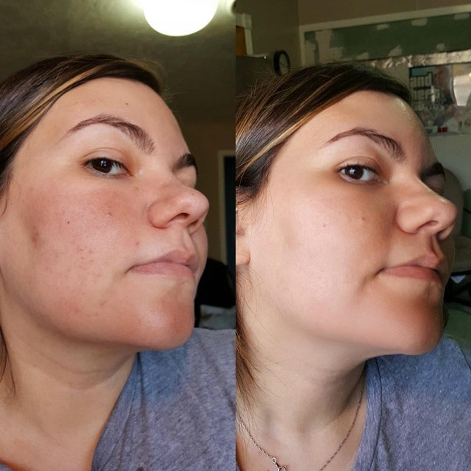 glutathione rosacea MSM, the Anti-Aging and Rosacea Hero You Didn't Know You Needed – SkinFoodFix glutathione rosacea MSM, the Anti-Aging and Rosacea Hero You Didn't Know You Needed – SkinFoodFix
