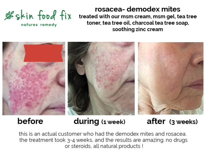 rosacea demodex mite