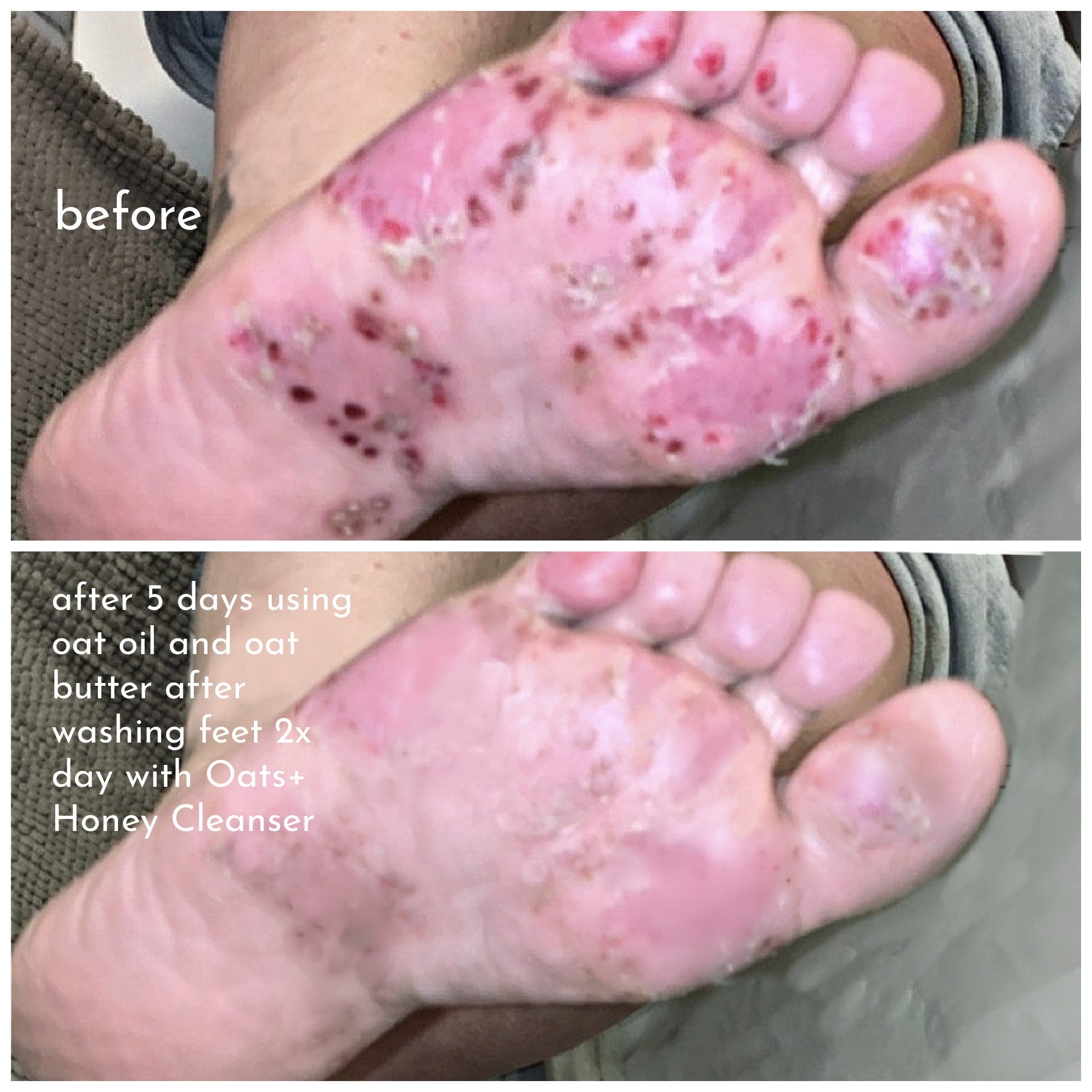 Palmoplantar pustulosis