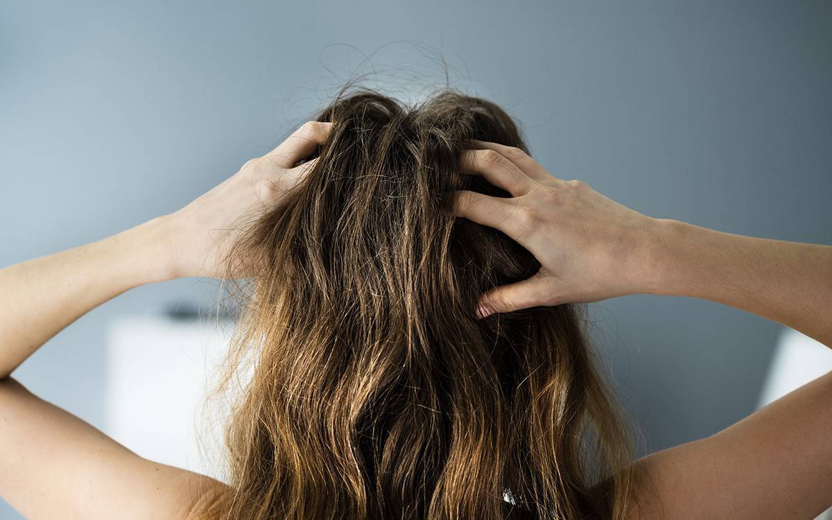 Understanding Dandruff: Why It Happens and How to Heal It Naturally