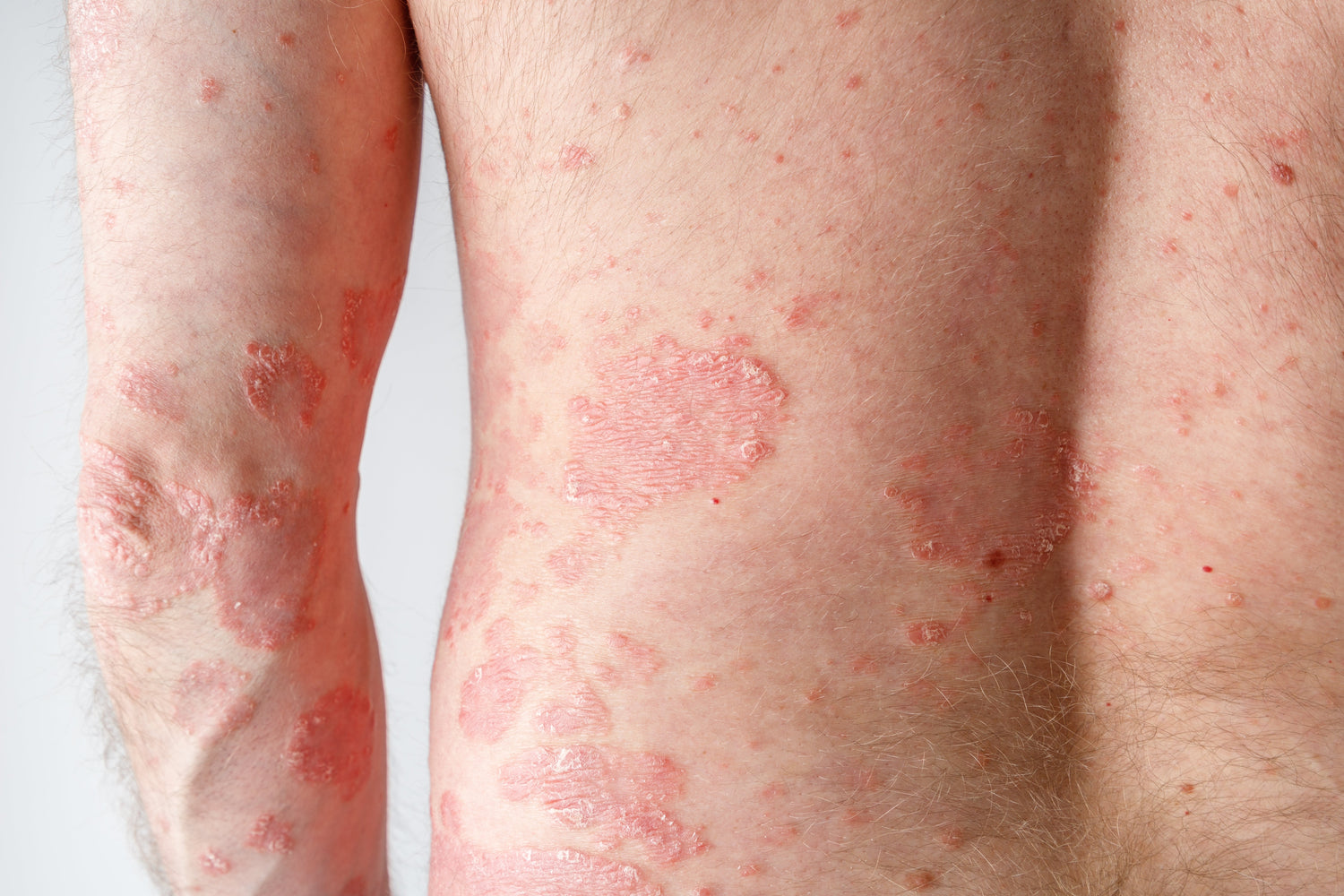 Pityriasis Rosea: Causes, Symptoms, and Natural Solutions